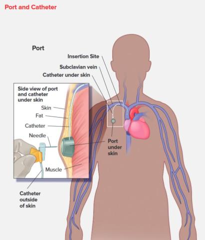 Port and Catheter