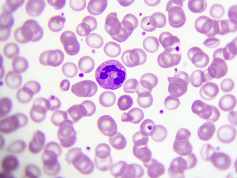 5 ESSENTIAL FACTS YOU SHOULD KNOW ABOUT LEUKEMIA | Leukemia and Lymphoma Society