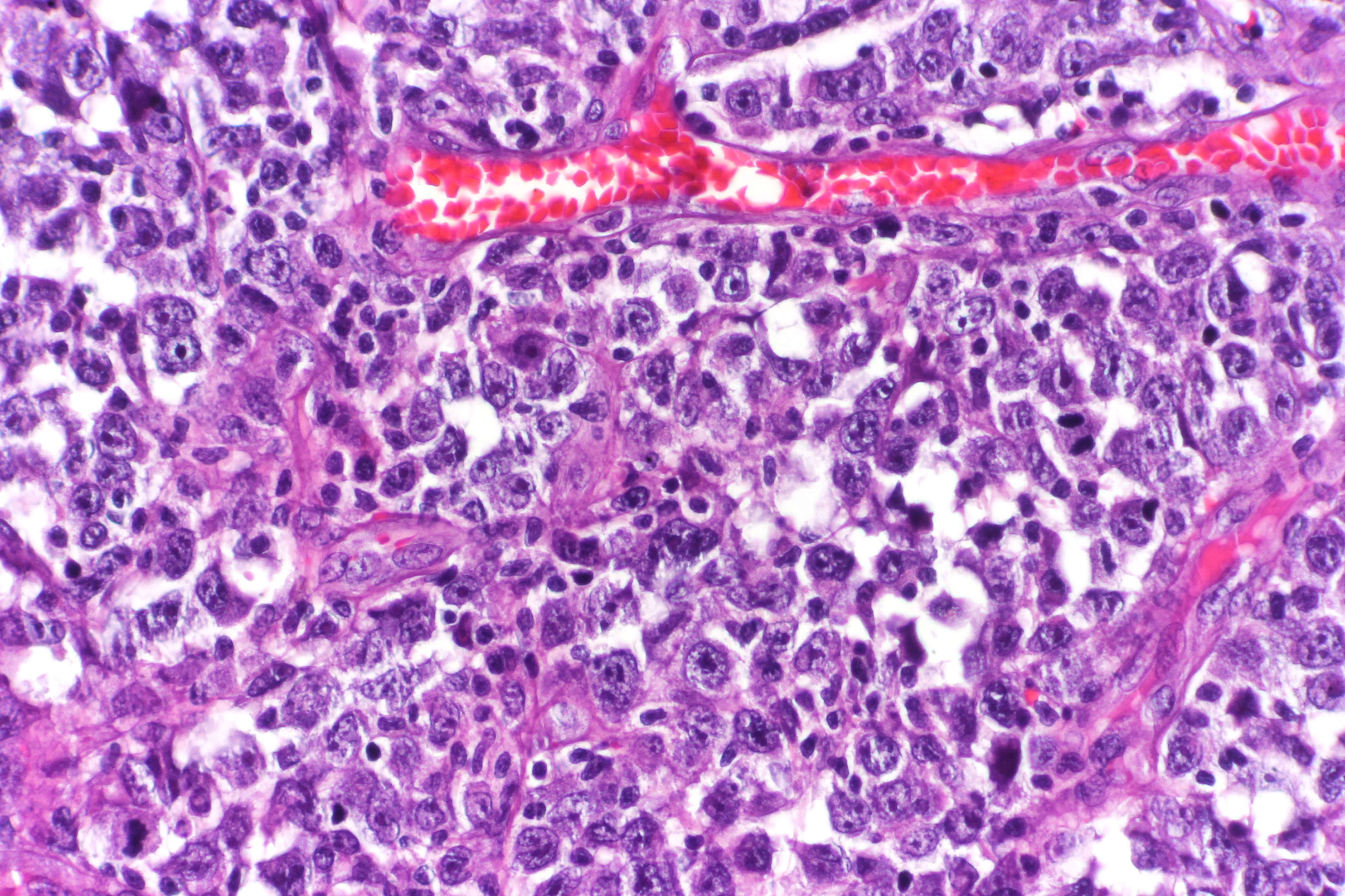 Diffuse Large BCell Lymphoma (DLBCL) Leukemia and Lymphoma Society