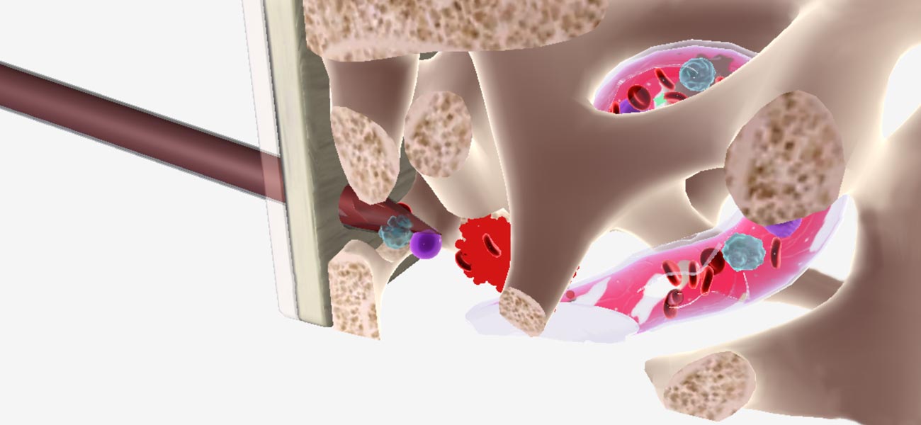 Bone Marrow Biopsy and Aspiration 3D Model | Leukemia and Lymphoma Society