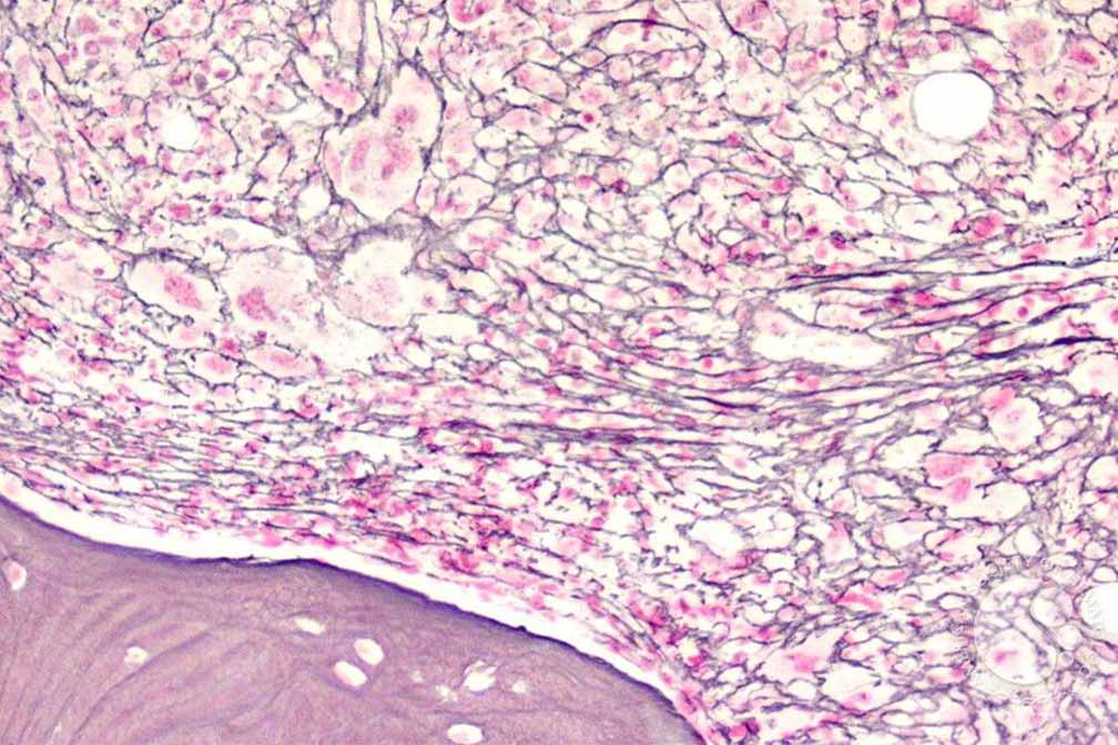 Myeloproliferative Neoplasms Myeloproliferative Neoplasms