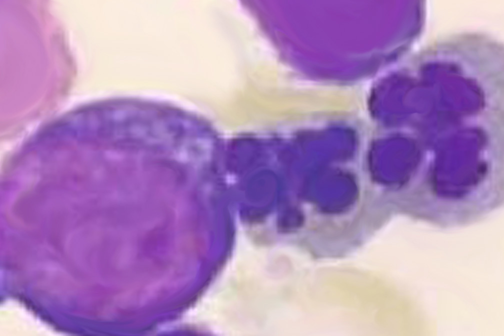 Myelodysplastic Syndromes Myelodysplastic Syndromes