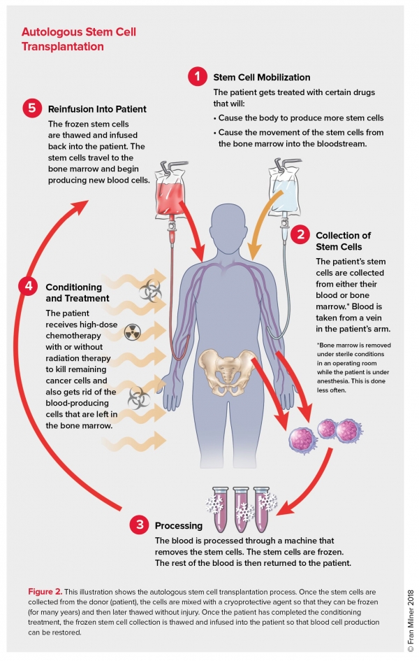 Autologous Stem Cell Transplantation Leukemia And Lymphoma Society