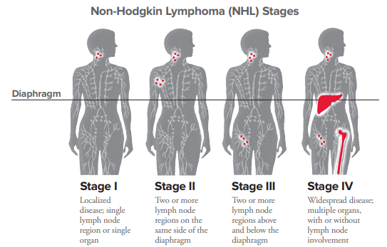 Nhl Staging | Leukemia And Lymphoma Society