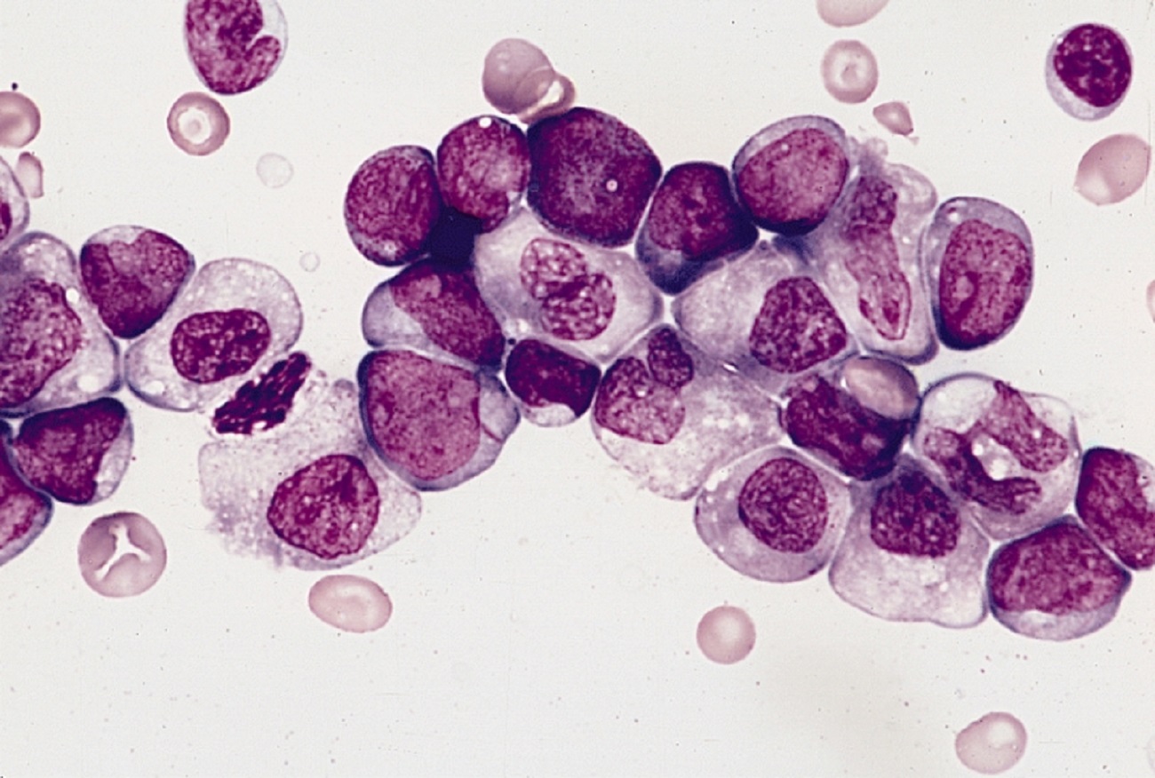 AML cells under the microscope