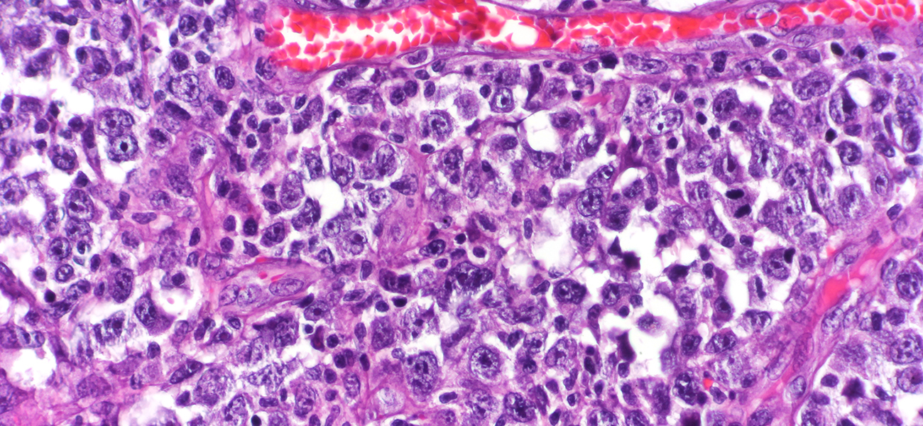 Diffuse large b-cell lymphoma