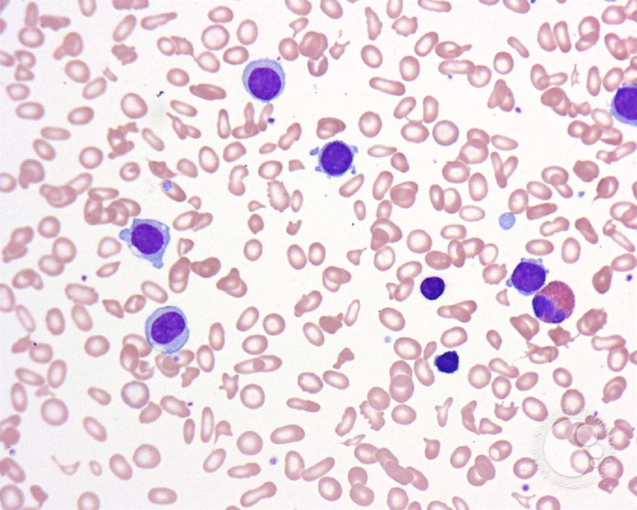 hairy cell leukemia