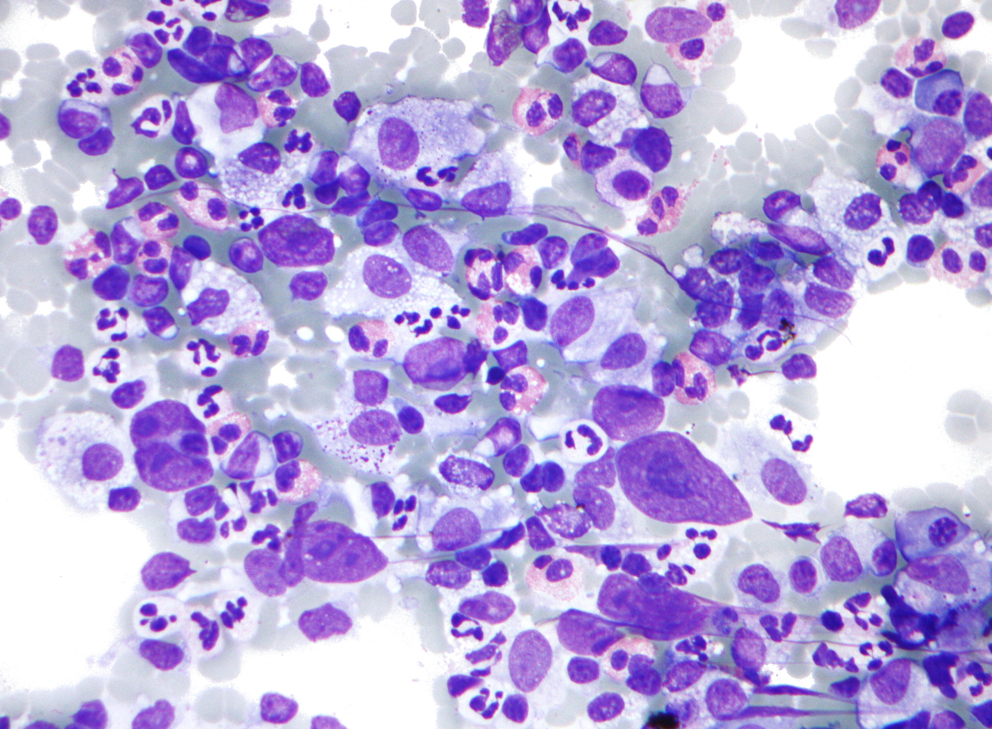 hodgkins lymphoma