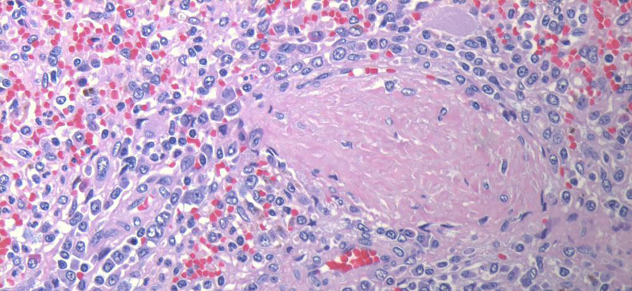 marginal zone lymphoma