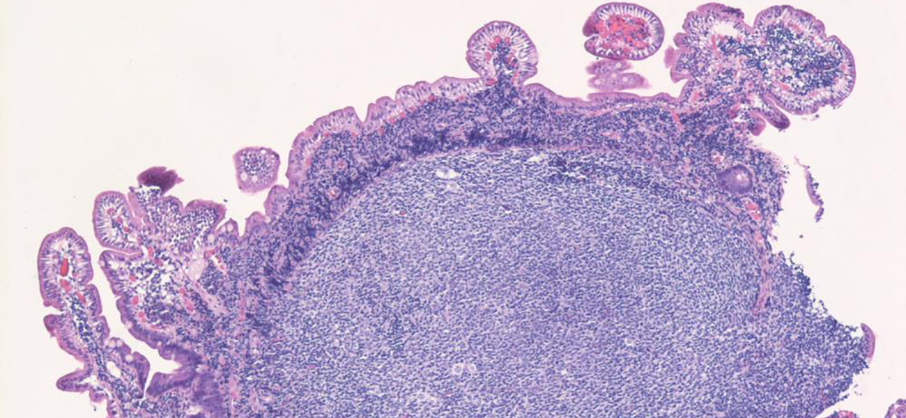 Follicular lymphoma