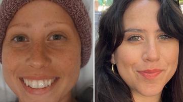 Split image of Racheli, Hodgkin lymphoma survivor. On the right, her during treatment. On the left, post-treatment.