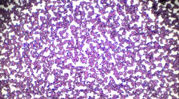 microscope image of leukemia cells