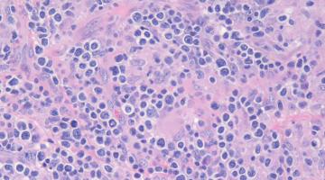t-cell lymphoma