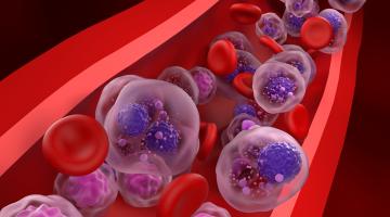 Multiple myeloma webinar