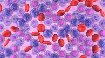 Acute Myeloid Leukemia