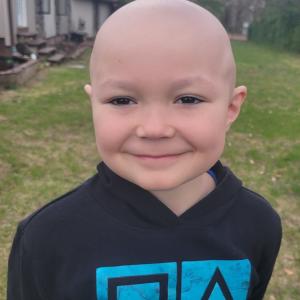 acute lymphoblastic leukemia (B-ALL)