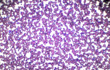 microscope image of leukemia cells